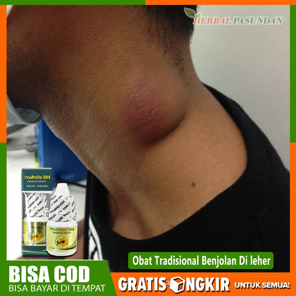 Traditional MEDICINE FOR BUMPS ON THE NECK - ORIGINAL YOGYAKARTA SM ...
