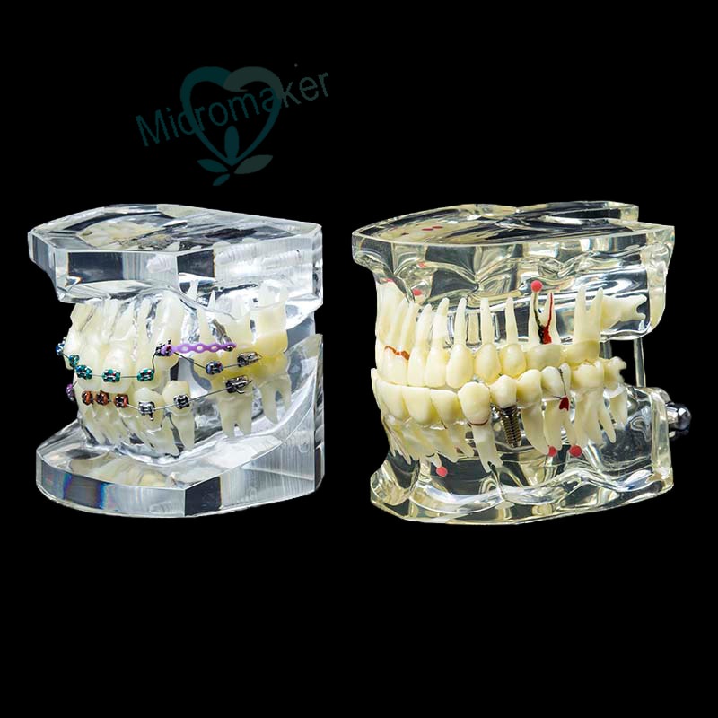 1Pc Dental Orthodontic Study Teach Teeth Model with Metal Brackets ...