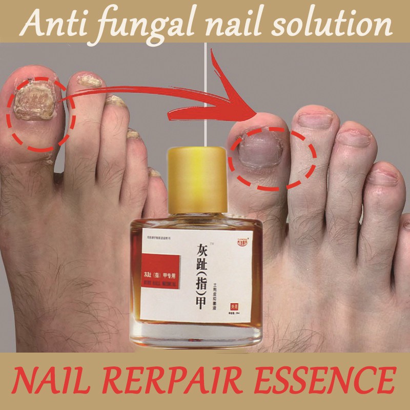 Treatment of fungal infections nail onychomycosis repair liquid restore