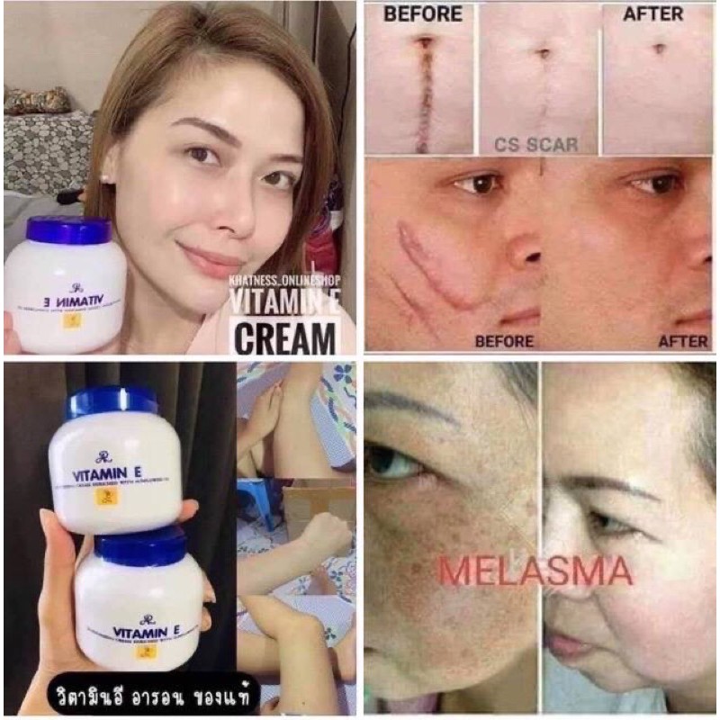 VITAMIN E CREAM Merawat Stretch marks Sunburn selulit Melasma pekas