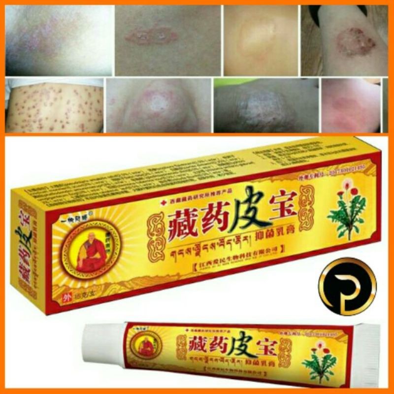 ECZEMA TREATMENT ANTI BACTERIAL FUNGUS CREAM 🔥READY STOCK🔥 | Shopee ...