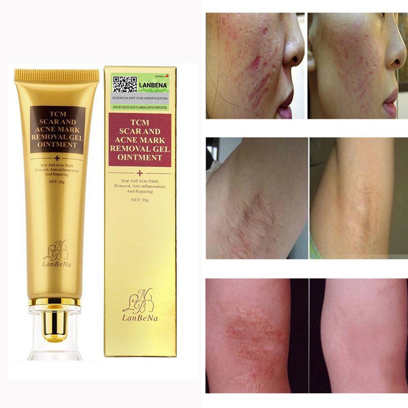 LANBENA SCAR Acnes Stretch Marks Keloid Skin Burns Removal Gel Cream ...