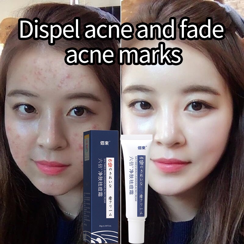Acne cream Acne Treatment Gel 30g 6 times shark fat Repair acne