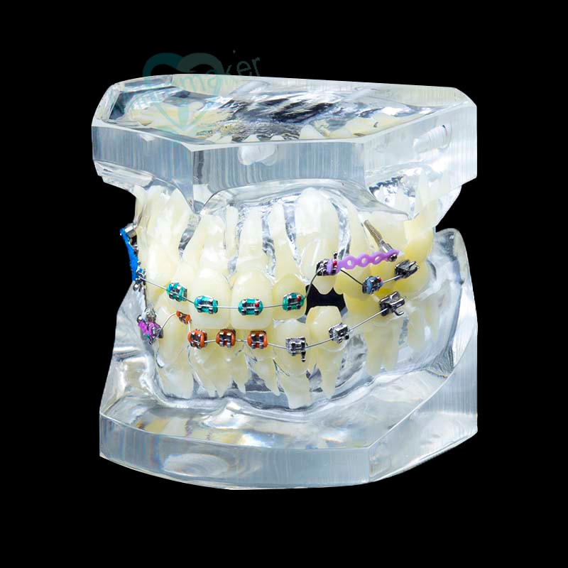 1Pc Dental Orthodontic Study Teach Teeth Model with Metal Brackets ...