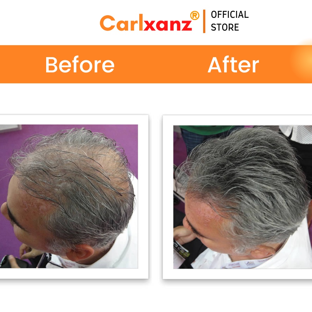 Carlxanz Hair Fiber Hide Bald Spot & Thinning Hair (4 x 25g) | Shopee ...