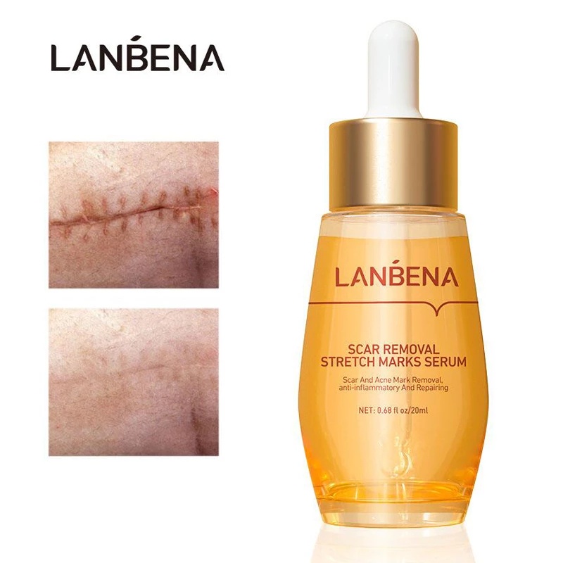 LANBENA Acne Scar Remove Serum Acne Treatment Remover Cream | Shopee