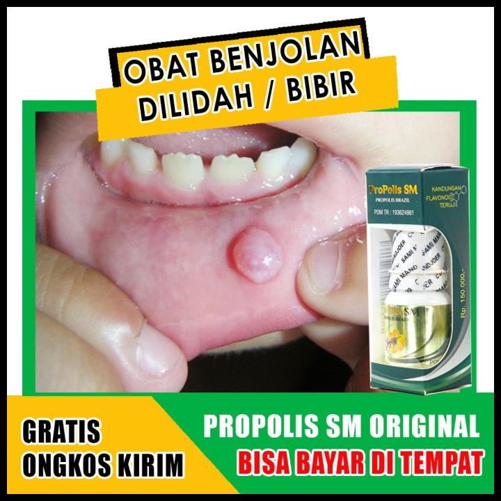 Medicine For Lumps Under The Tongue/On The Lips/Mukokel Propolis Sm