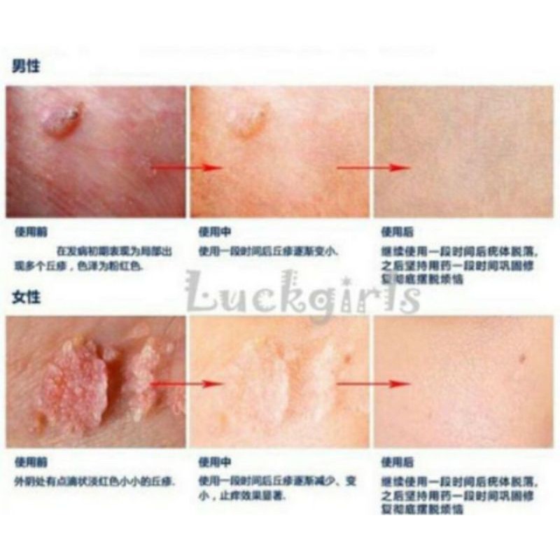 Difference Between Genital Warts And Skin Tags