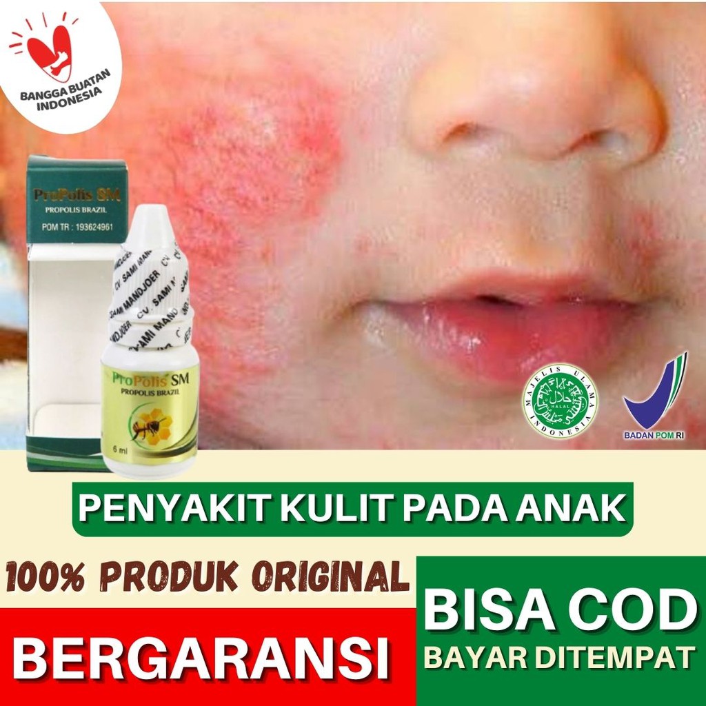 Bruntusan Child Eczema Drugs Sweat Rash Rash Dry Skin Diapers ...