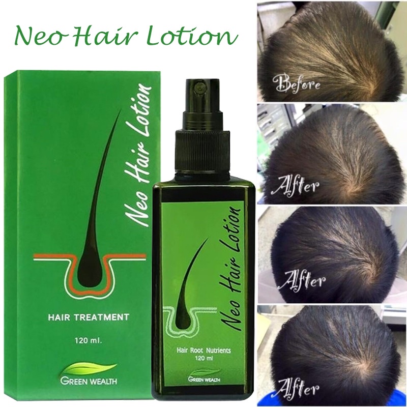 Neo Hair Lotion Hair Growth Serum Essence Oil Hair Loss Treatment Shopee Malaysia 7023