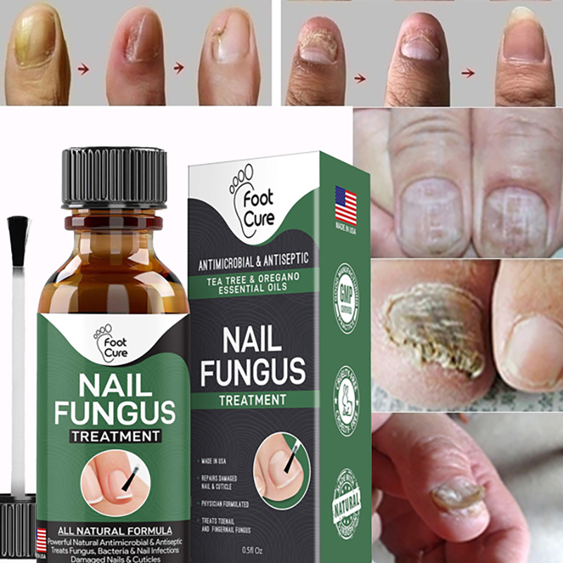 EXTRA STRONG Nail Fungus Treatment, Best Nail Repair, Stop Fungal ...