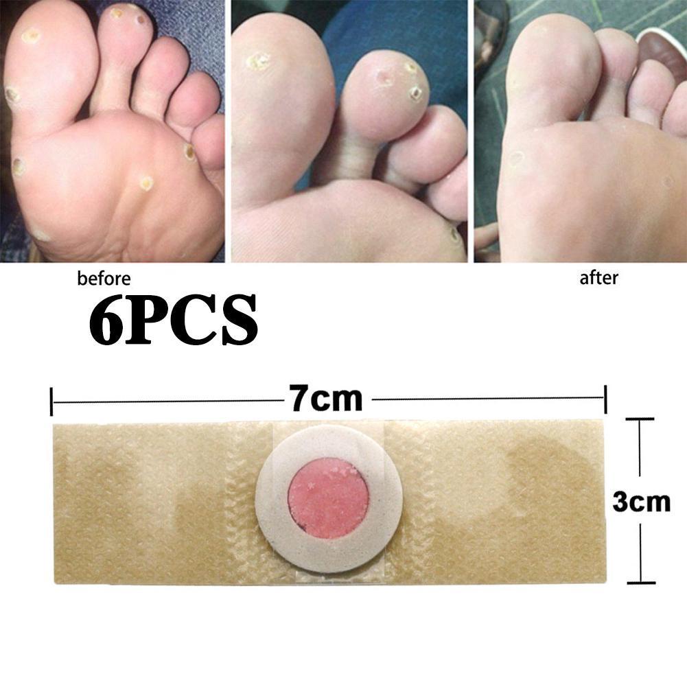 6Pcs Feet Corns/ Warts plaster Removal Patch Pain Relief Remover Callus ...