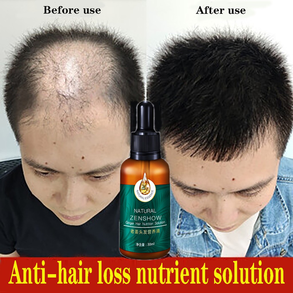 Hair growth essence Hair tonic for hair growth 30ml Anti hair fall ...