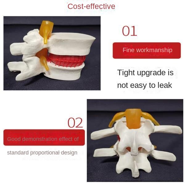 Human Spine Lumbar Intervertebral Disc Protrusion Model Magnification ...