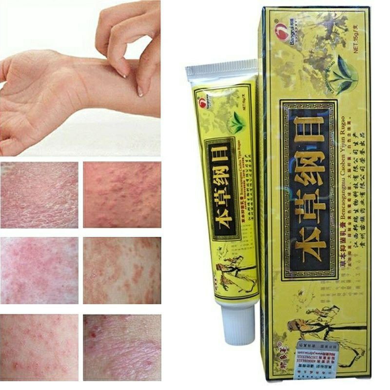 KRIM EKZEMA-Ointment Psoriasis Eczema Dermatis Itchy Gatal Relief 15g ...