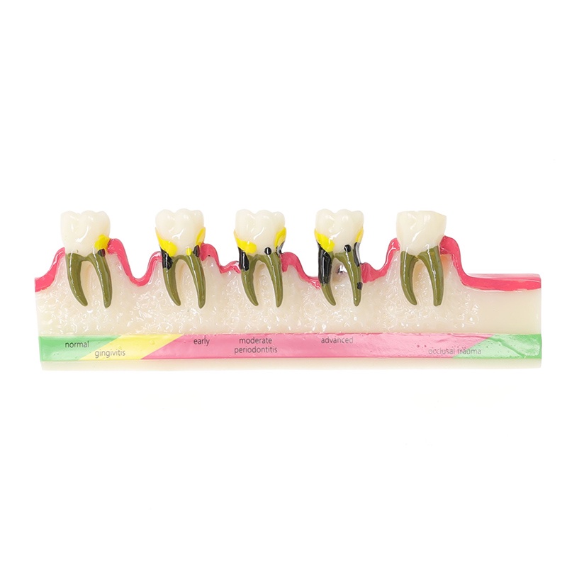 Dental Periodontal Model Tooth Study Teaching Model for School /Lab ...