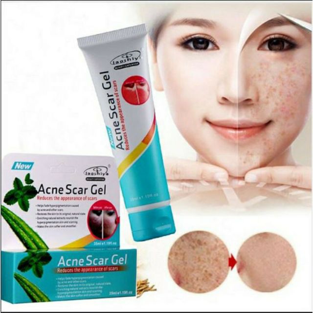 Aloe Vera Acne Scar Gel, Acne Scar Treatment, Acne Pimple Spot Scar 