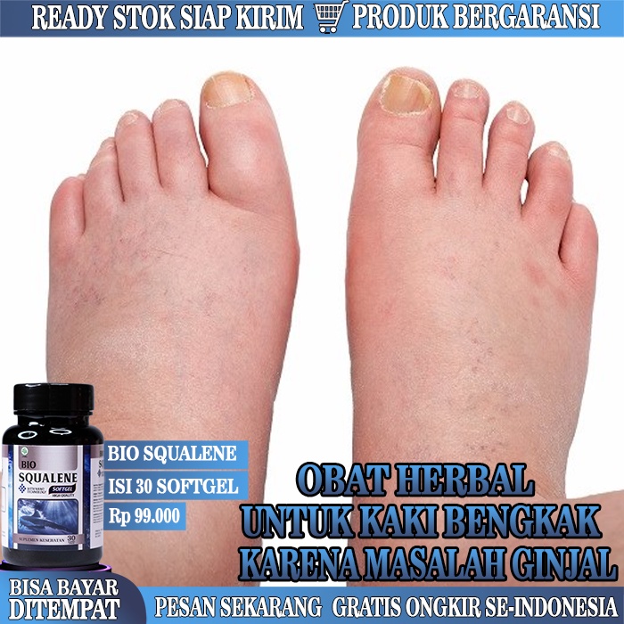 Medicine For Legs Swelling Becauses Kidney Pain, Legs Swelling