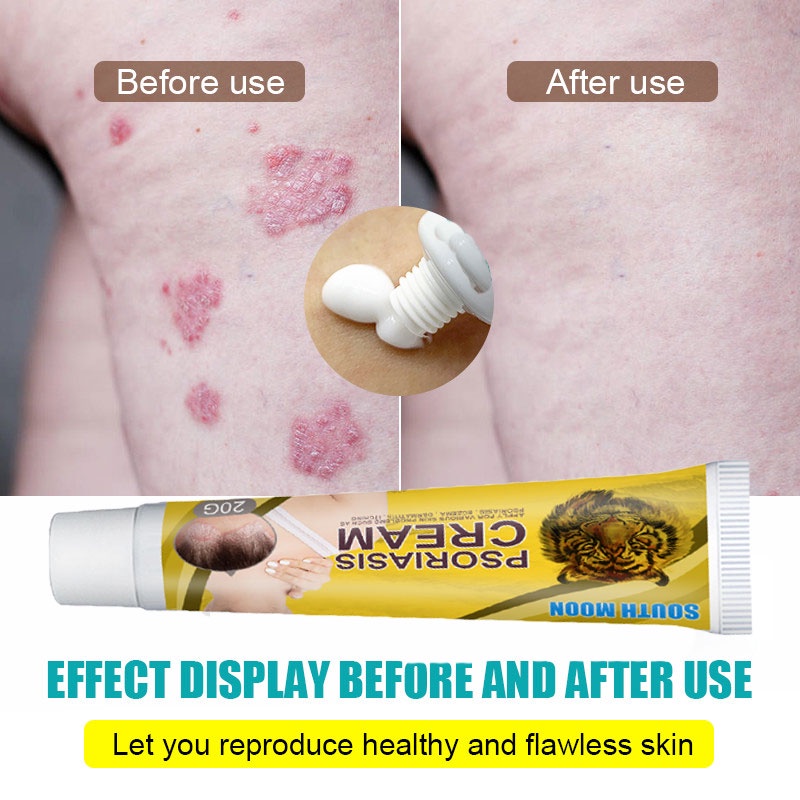 Psoriasis Remove Cream Eczema Ointment Scalp Psoriasis Hand Tinea Foot