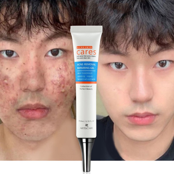 Acne remover cream Pimple eraser Pimple marks remover Moisturizer acne