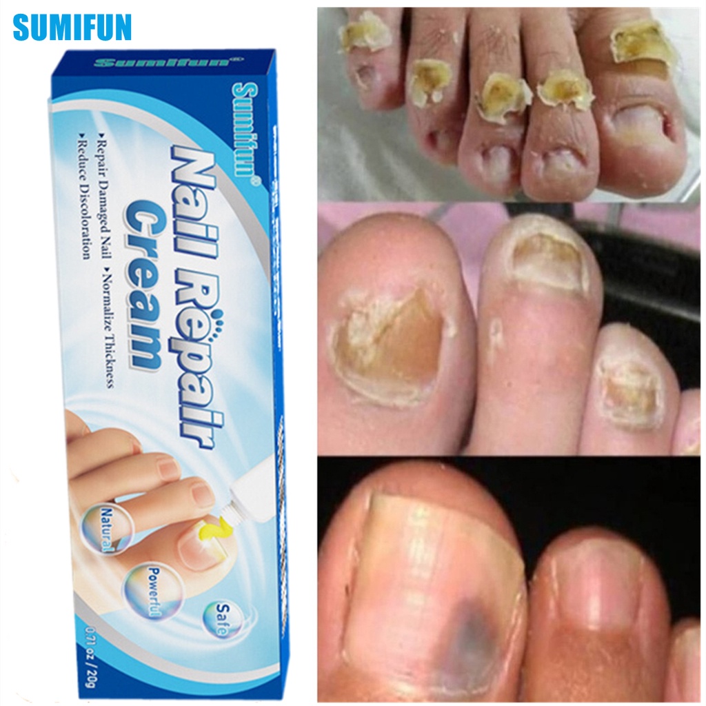 Sumifun Effective Nail Treatments Cream Nail Fungus Removal Cream
