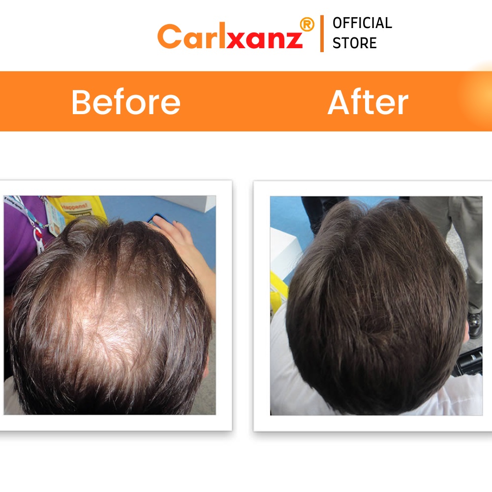 Carlxanz Hair Fiber Hide Bald Spot & Thinning Hair (4 x 25g) | Shopee ...