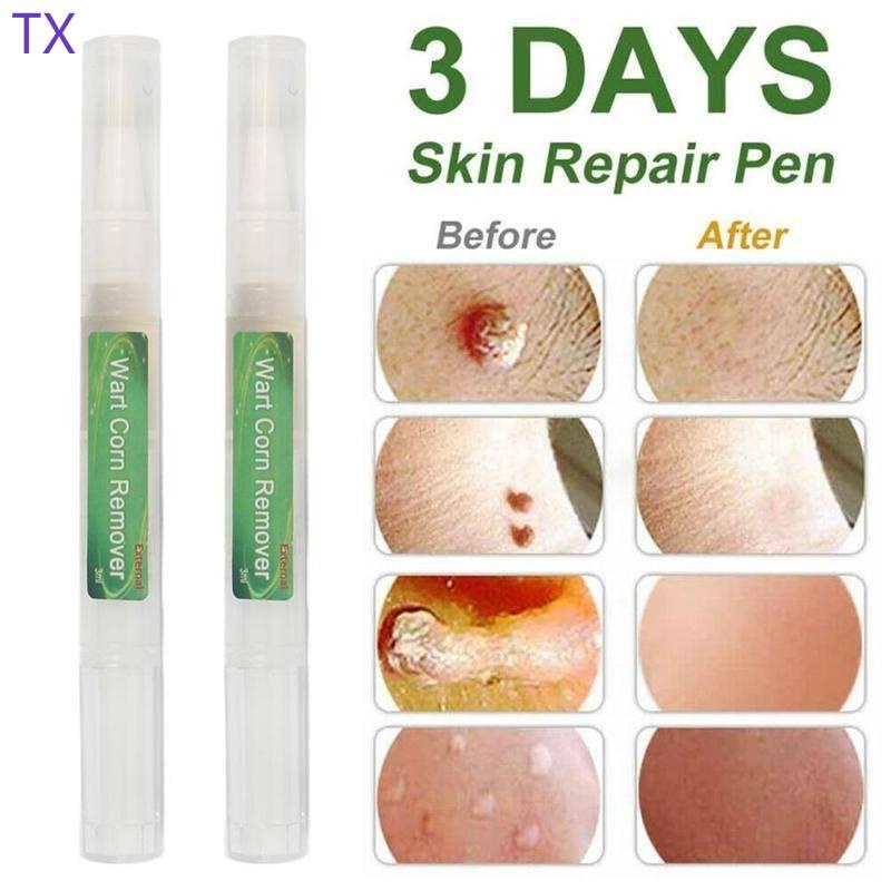 Wart Corn Remover Pen Clean Genital Warts Moles Papillomas Treatment ...