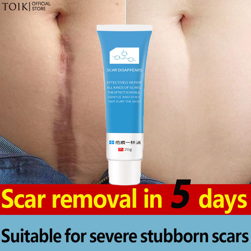 Scar Remover for Old Scar on Leg Stretch Mark Remover Acne Scar Remover ...
