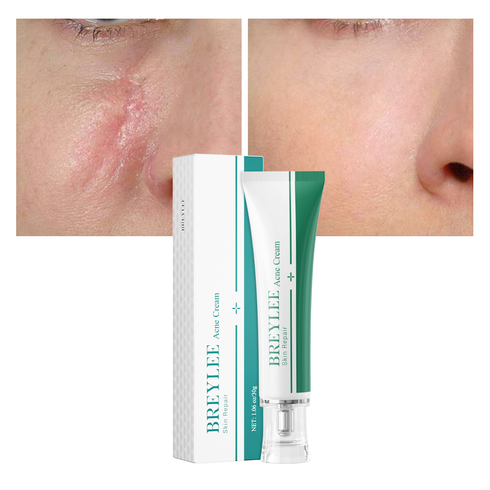 BREYLEE Scar Removal Cream 30g Treatment Remove Stretch Marks Whitening Cream Shopee Malaysia