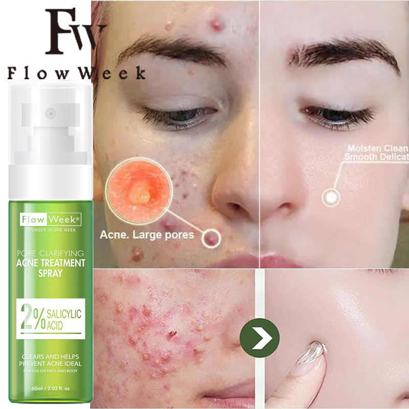 Flow Week 60ml Effective Acne Removal Spray Treatment Acne Scar Spots