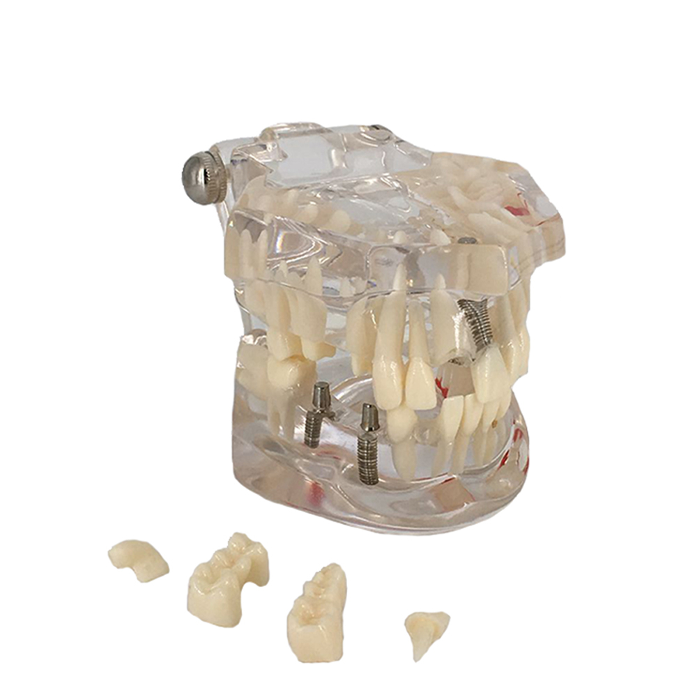 Implant Dental Disease Teeth Model With Restoration Bridge Tooth For ...