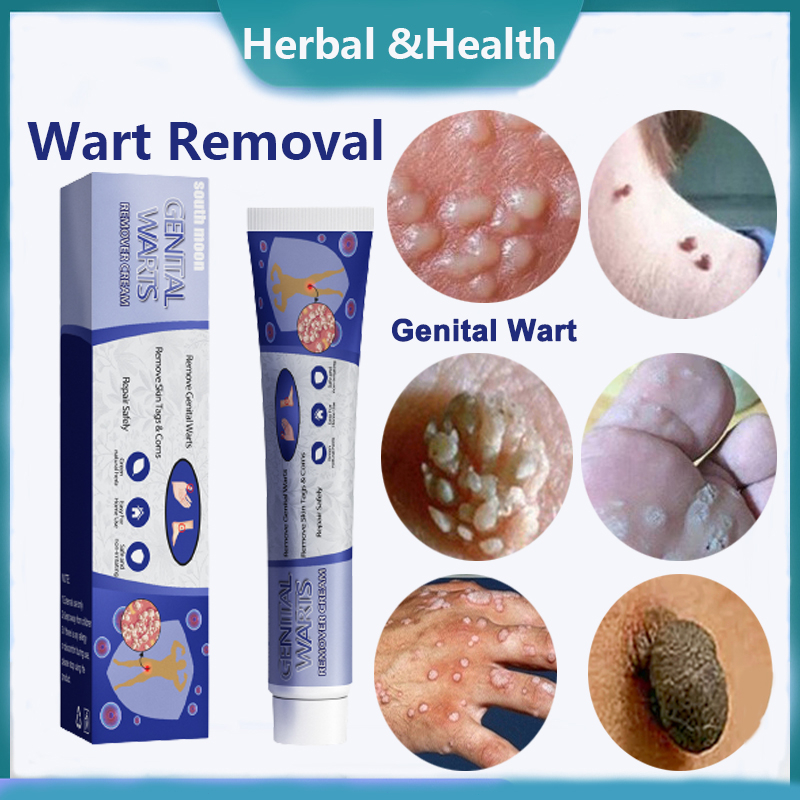 Wart Removal Cream Genital Wart Removal Cream Mole Skin Tag Remover