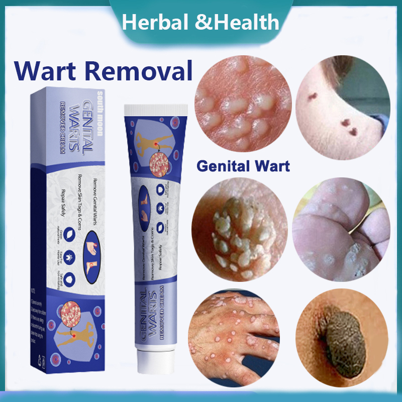 Wart Removal Cream Genital Wart Removal Cream Mole Skin Tag Remover Mole Mole Repellent 克疣膏20g 1325