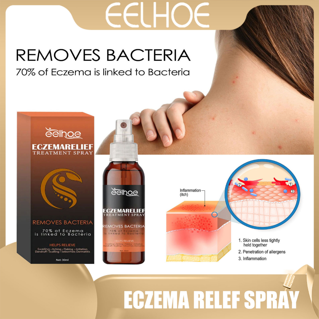 Eelhoe Eczema Relief Treatment Spray Anti-Itch & Psoriasis Relief (30ml ...