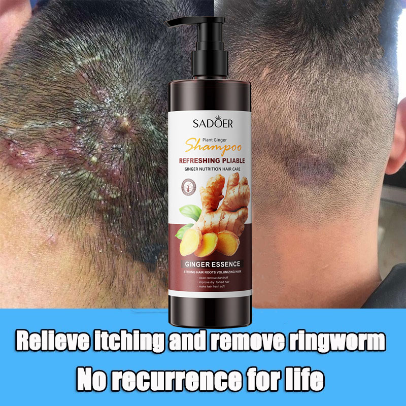 SADOERPsoriasis shampoo Farewell scab scalp and itchy antifungal