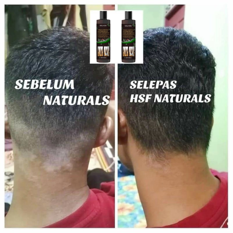 【Prevent hair loss】Syampoo Psoriasis scalp Itchy scalp Antifungal
