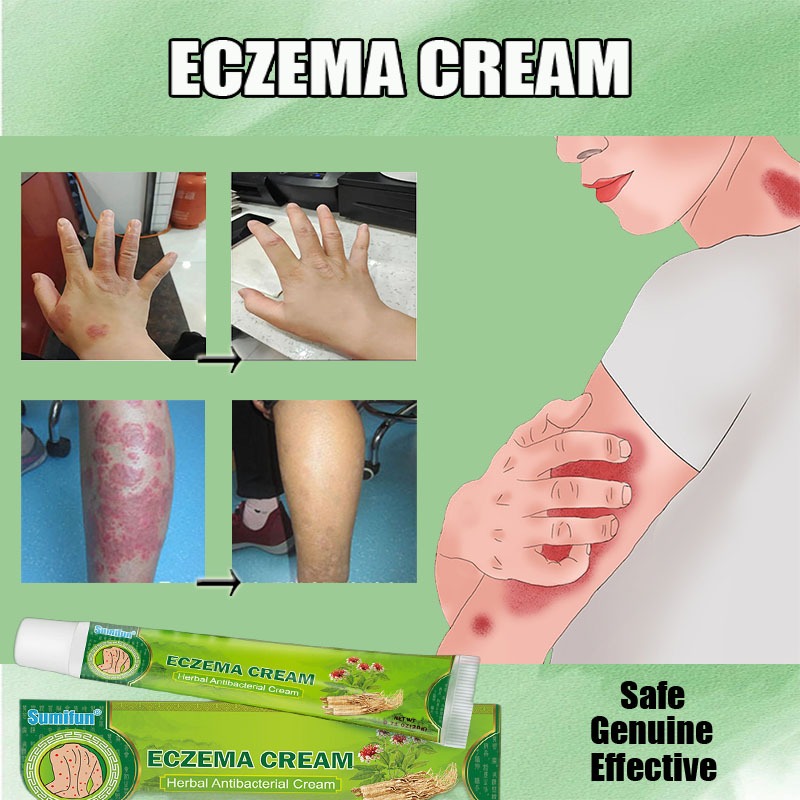 Sumifun Eczema Cream Dermatitis Antibacterial Cream 20g Herbal Itchy ...