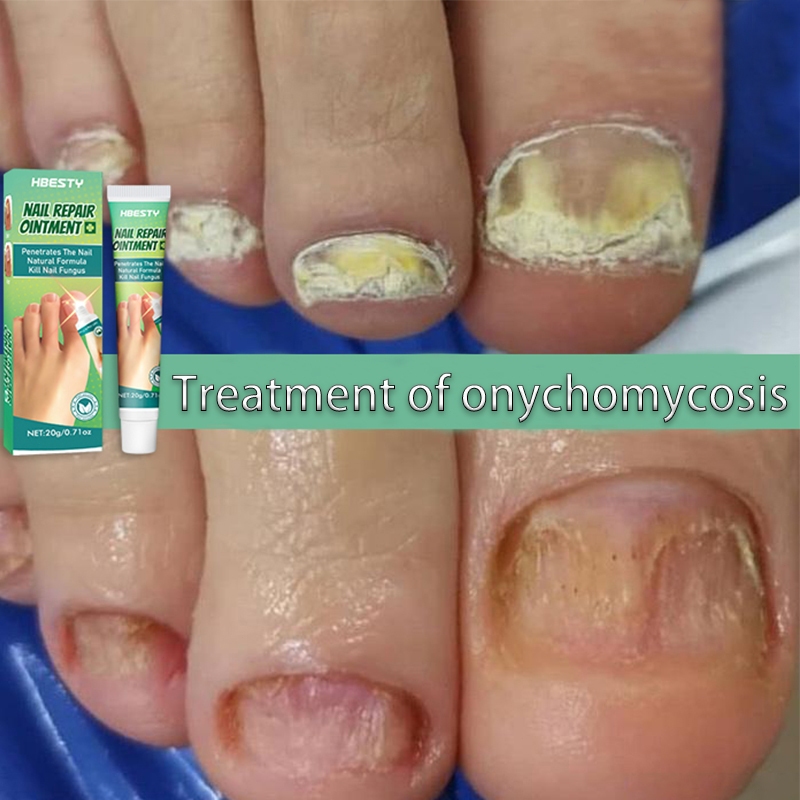 fungal nail treatment nail repair fungal nail 20g Quick Repair
