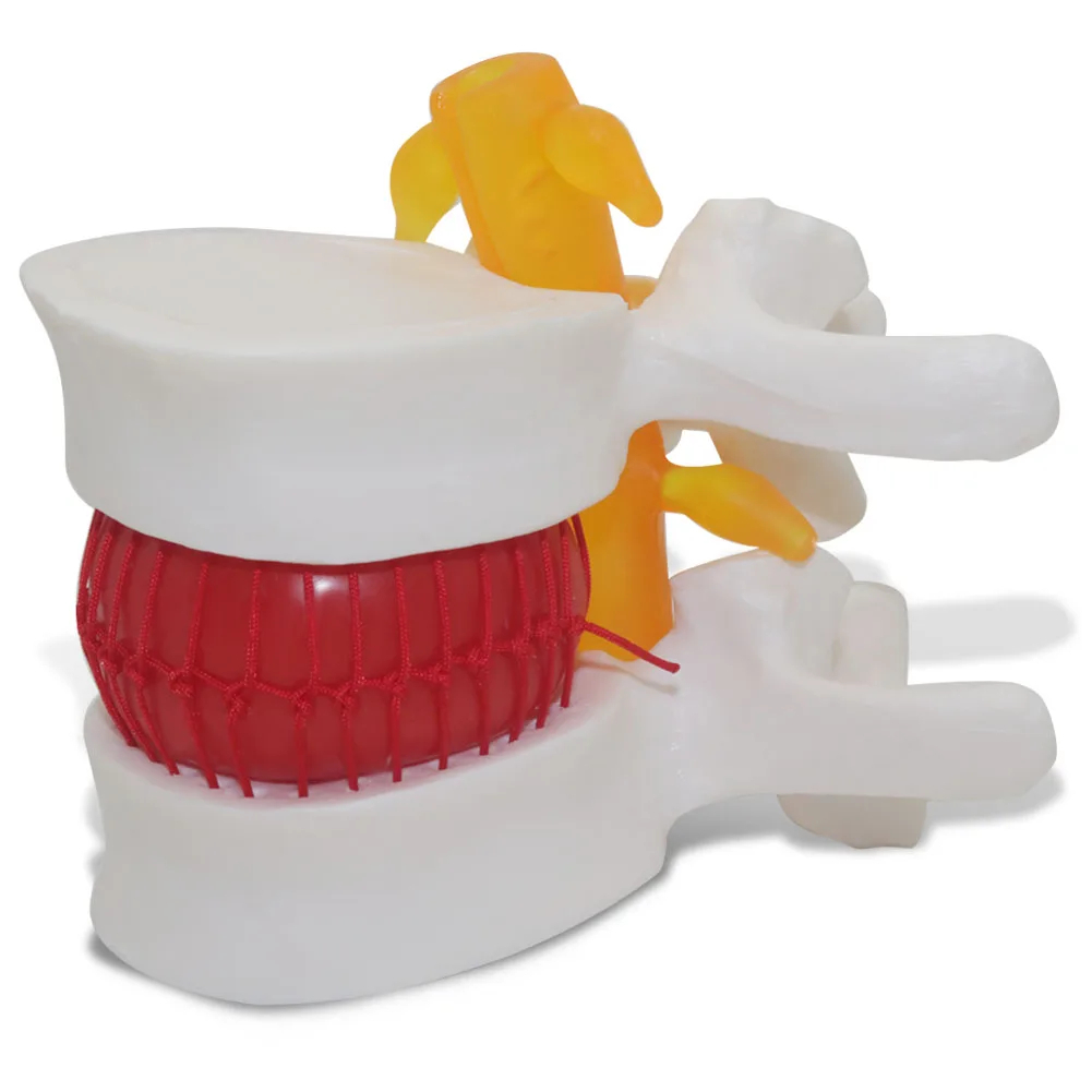 Medical Props Model Free postage Anatomical Spine Lumbar Disc ...