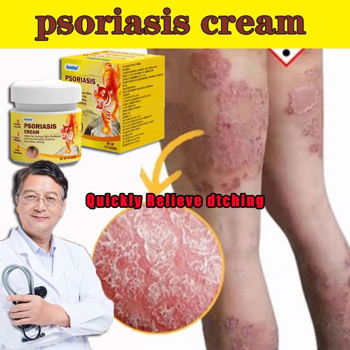 Itching cream Eczema cream Antifungal cream Psoriasis Cream 20G anti ...