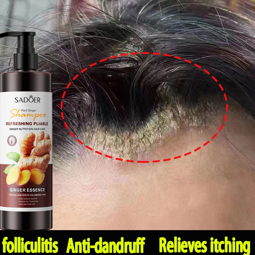 Ginger shampoo500ml Soriasis shampoo Farewell scab scalp Antihair loss