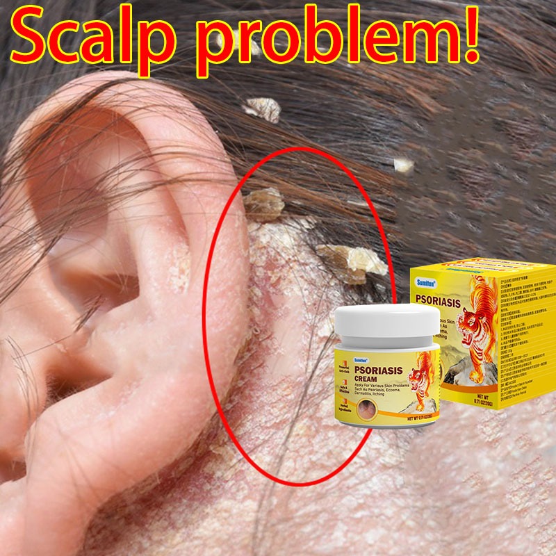 Itchy skin Kulit gatal itchy antifungal psoriasis scalp scalp itchy