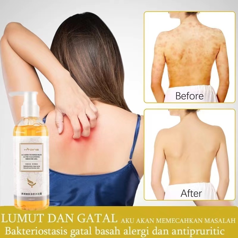 HYQING Body Acne Cleansing Shower Gel Ubat Jerawat Badan Acarid Tender