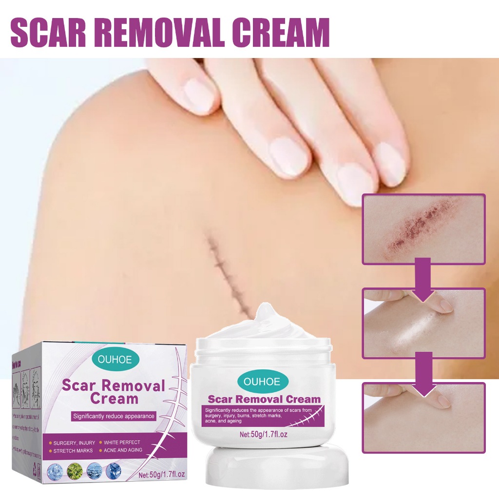 Scar Remover Cream Old Scar Remover Cream For Legs Peklat Stretch Mark ... - Acne Removal Cream For Legs