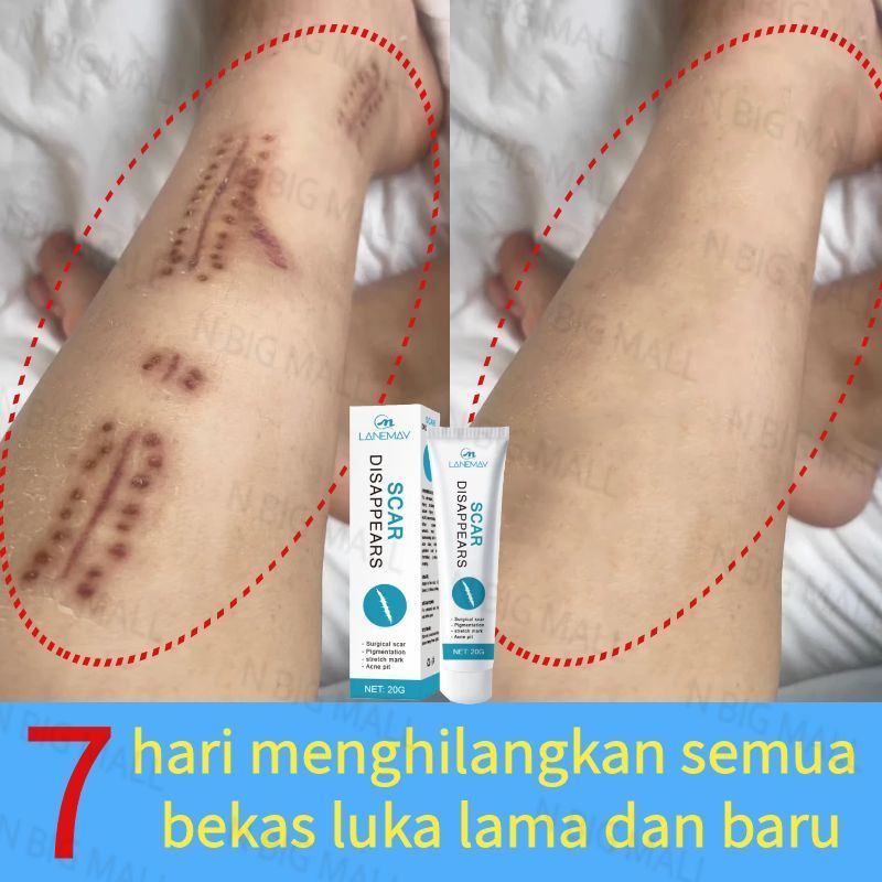 Scar Remover Cream Keloid Scar Remover Ointment Old Black Scabs Remove