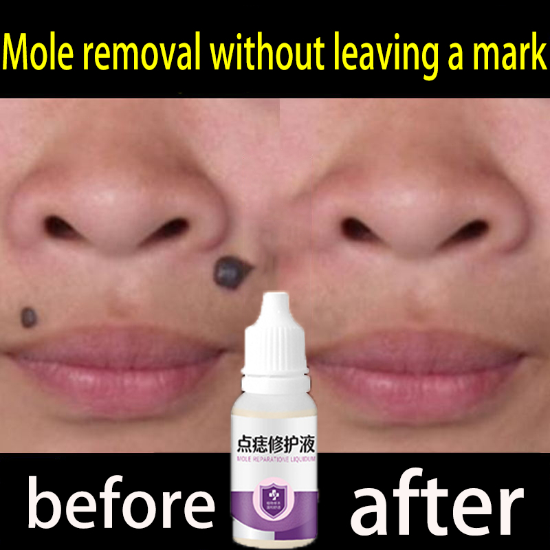 Mole spotting / mole fixing No scars Naevus repair liquid plant removal