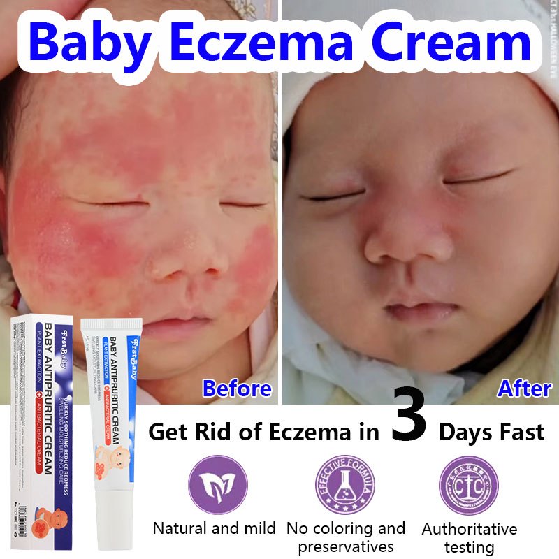 Baby Eczema Cream Baby Itch Relief Cream 15g Baby eczema, itching ...