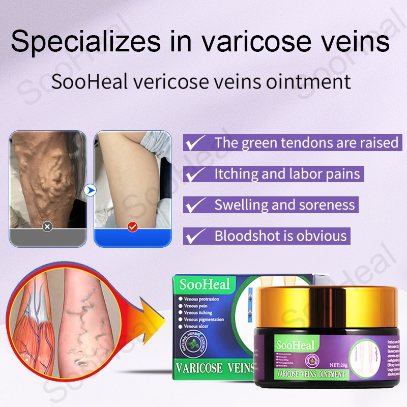varicose veins cream 20g Promote venous blood return repair blood ...