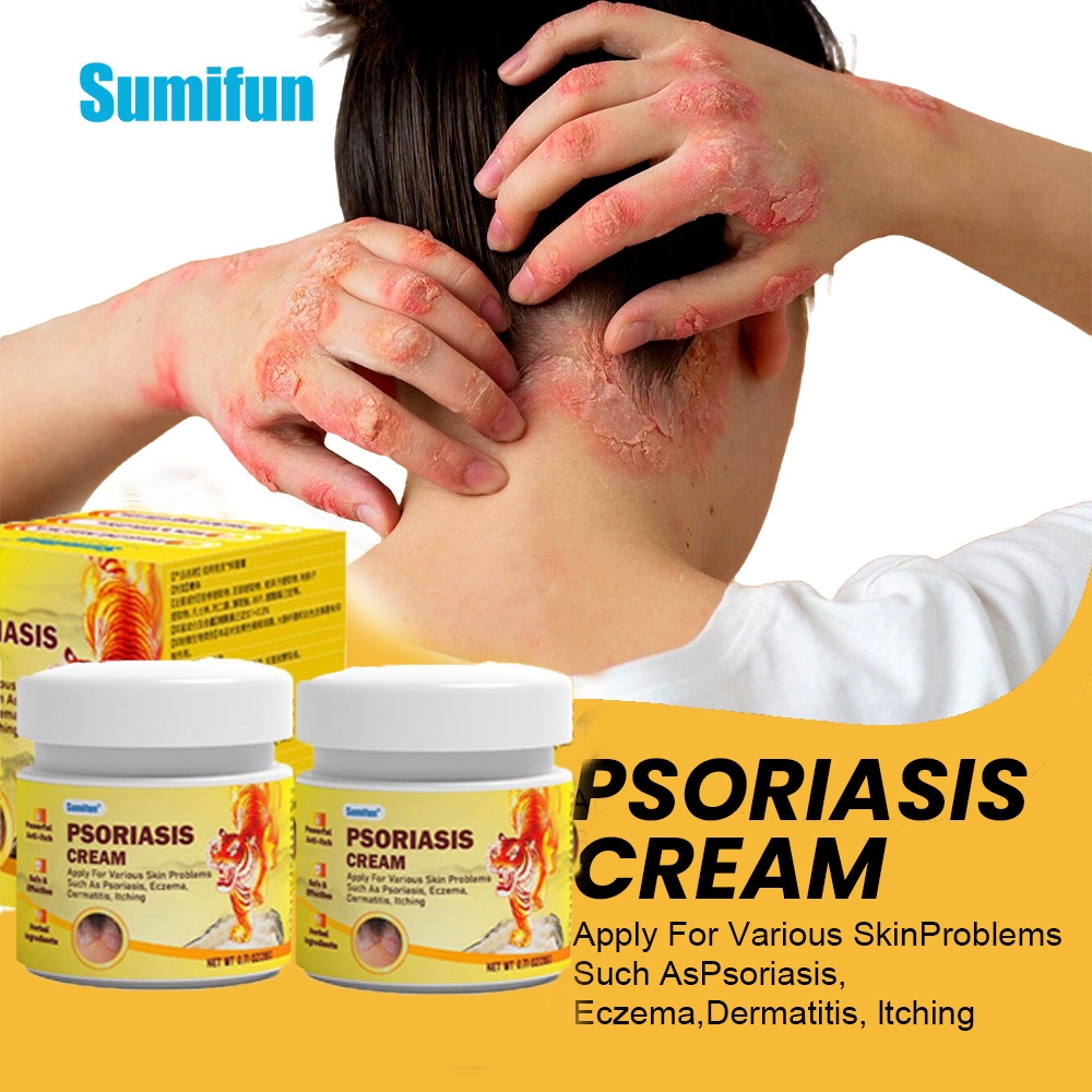 Psoriasis Cream Antifungal cream Eczema Gatal Kulit Krim Gatal Ubat ...