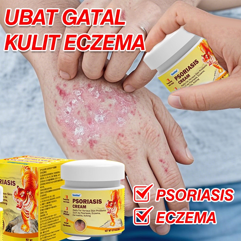 Sumifun 20g antifungal cream psoriasis cream Natural Herbal Psoriasis ...